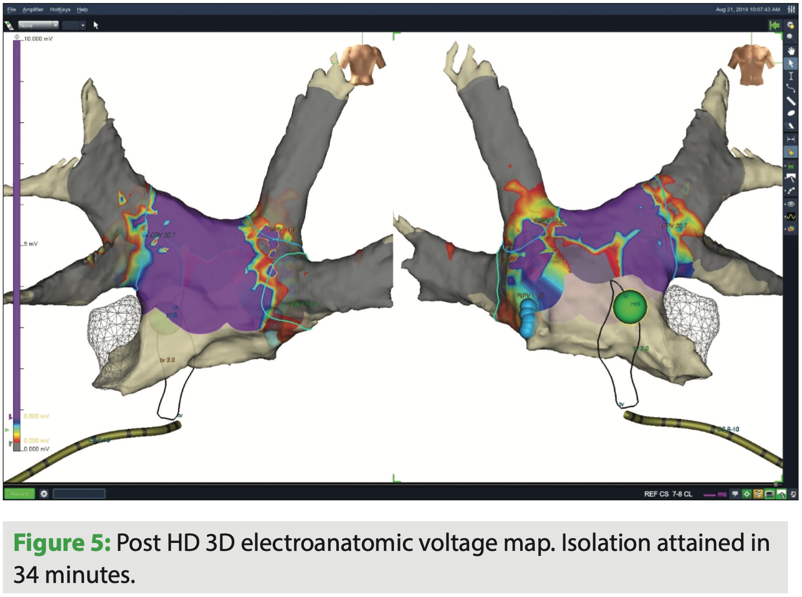 Radiofrequency Ablation of Atrial Fibrillation Modern Tools and